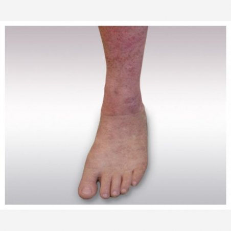 Foot prosthesis
