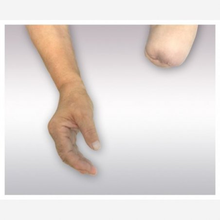 Forearm prostheses-1
