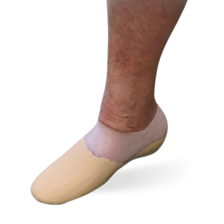 Insole after partial foot amputation