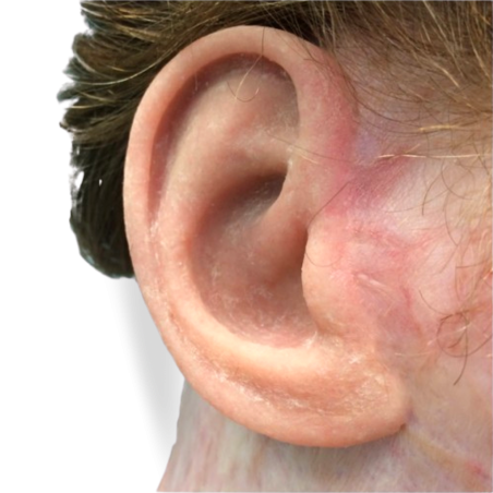 Ear prosthesis  -2