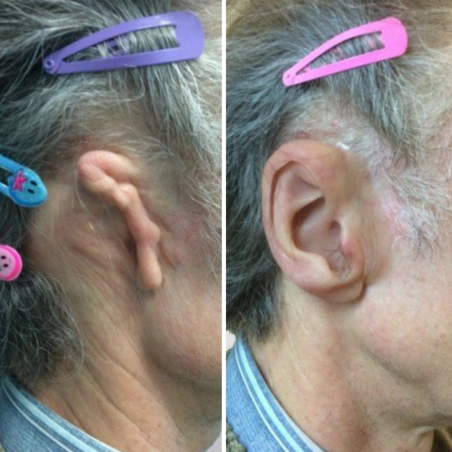 Ear prosthesis - 3