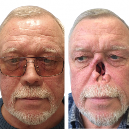 Nose prosthesis