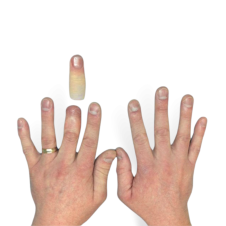 Протез пальца - 2