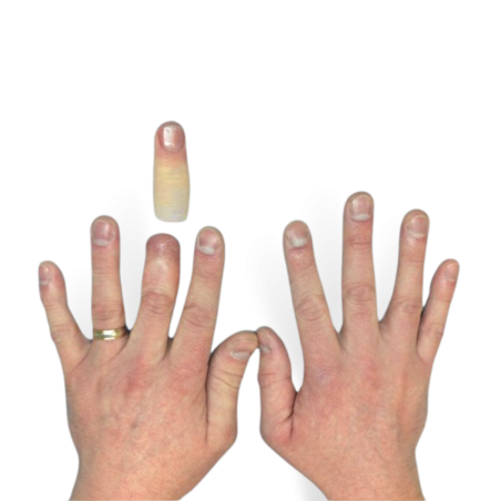 Finger prosthesis - 2