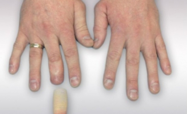 Pictures of hand prostheses